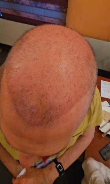 Под анестезией: шоумен Сергей Соседов перенес сложную 13-часовую операцию