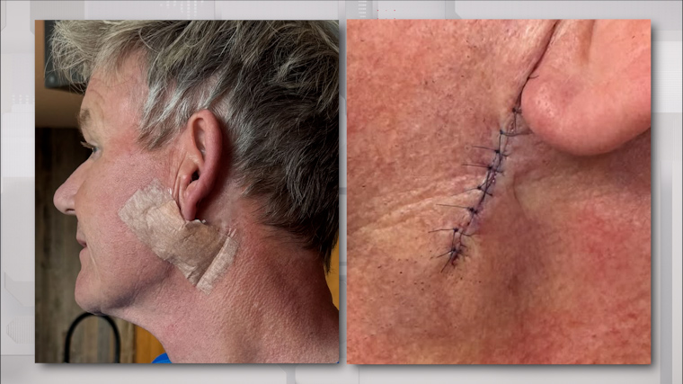 Удалили опухоль: британский шеф-повар Гордон Рамзи перенес сложную операцию